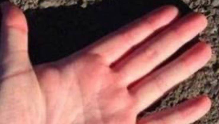 Mano di uomo con ustione sul plamo d'estate